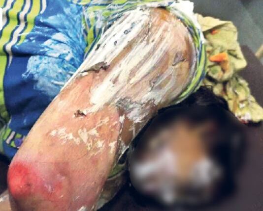 The rape accused, who was released on bail, burnt the victim alive
