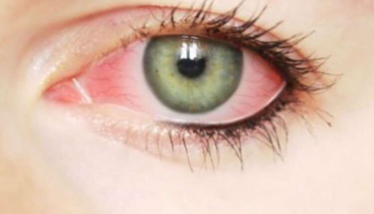 Pandemic black fungus havoc: 8848 patients in the country so farPandemic black fungus havoc: 8848 patients in the country so far