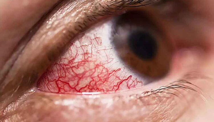 Kanpur: Black fungus wreaks havoc, 56-year-old woman had to have her eye removed after surgery