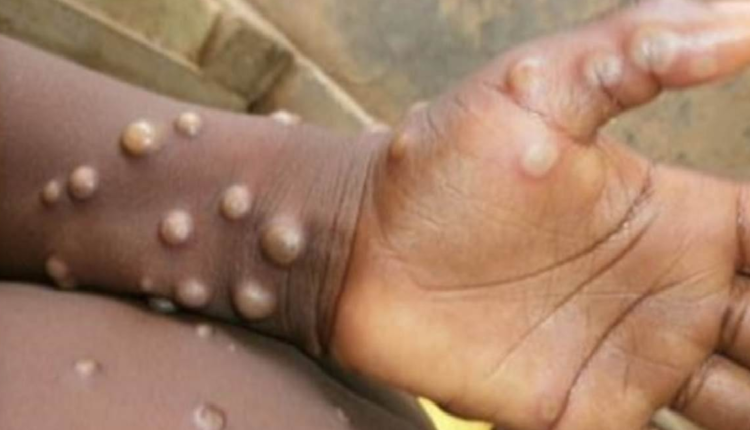 Monkeypox confirmed in Kerala man who returned from UAE