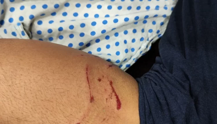 Dogs attacked a 14-year-old student living in Srishti Apartment badly bitten on his hand